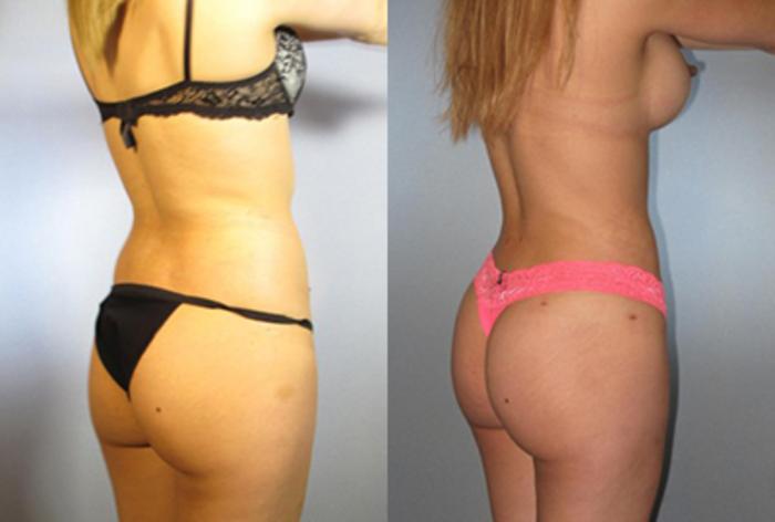 Before & After Brazilian Butt Lift Case 7838 View 1 View in Houston, TX