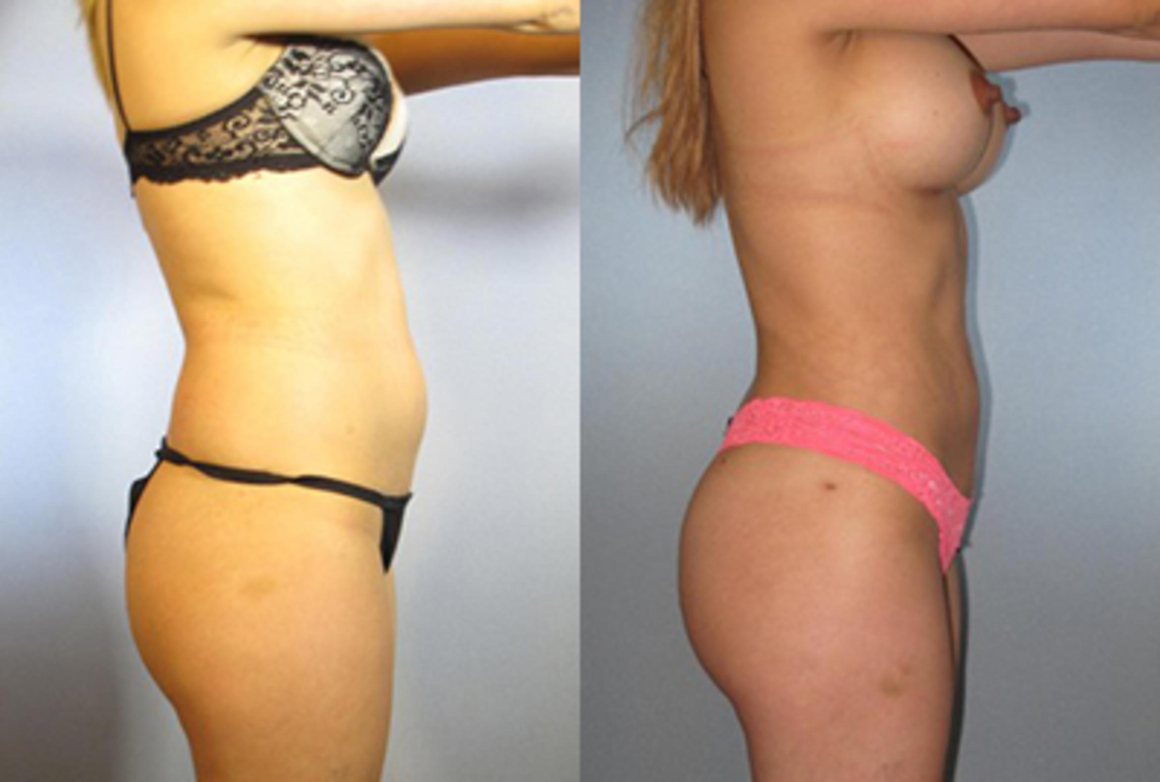 Before & After Brazilian Butt Lift Case 7838 View 2 View in Houston, TX