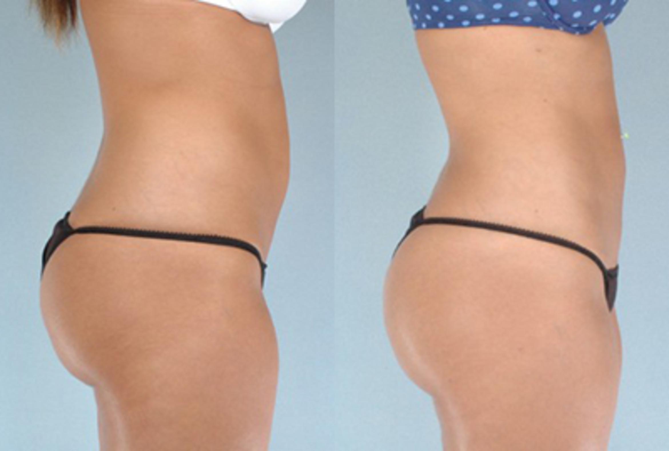 Before & After Brazilian Butt Lift Case 7893 View 1 View in Houston, TX