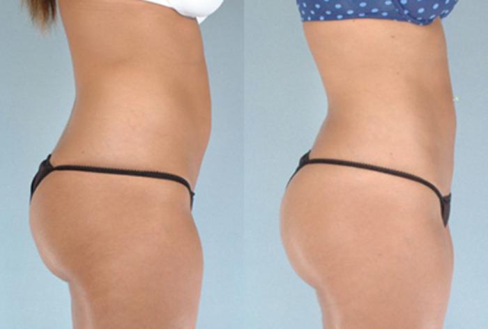 Before & After Brazilian Butt Lift Case 7893 View 1 View in Houston, TX