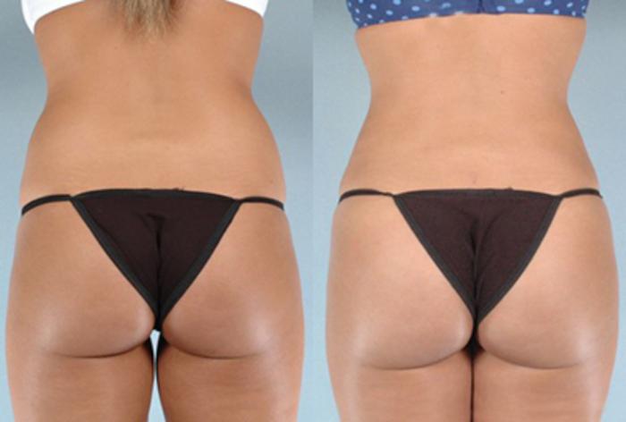 Before & After Brazilian Butt Lift Case 7893 View 2 View in Houston, TX