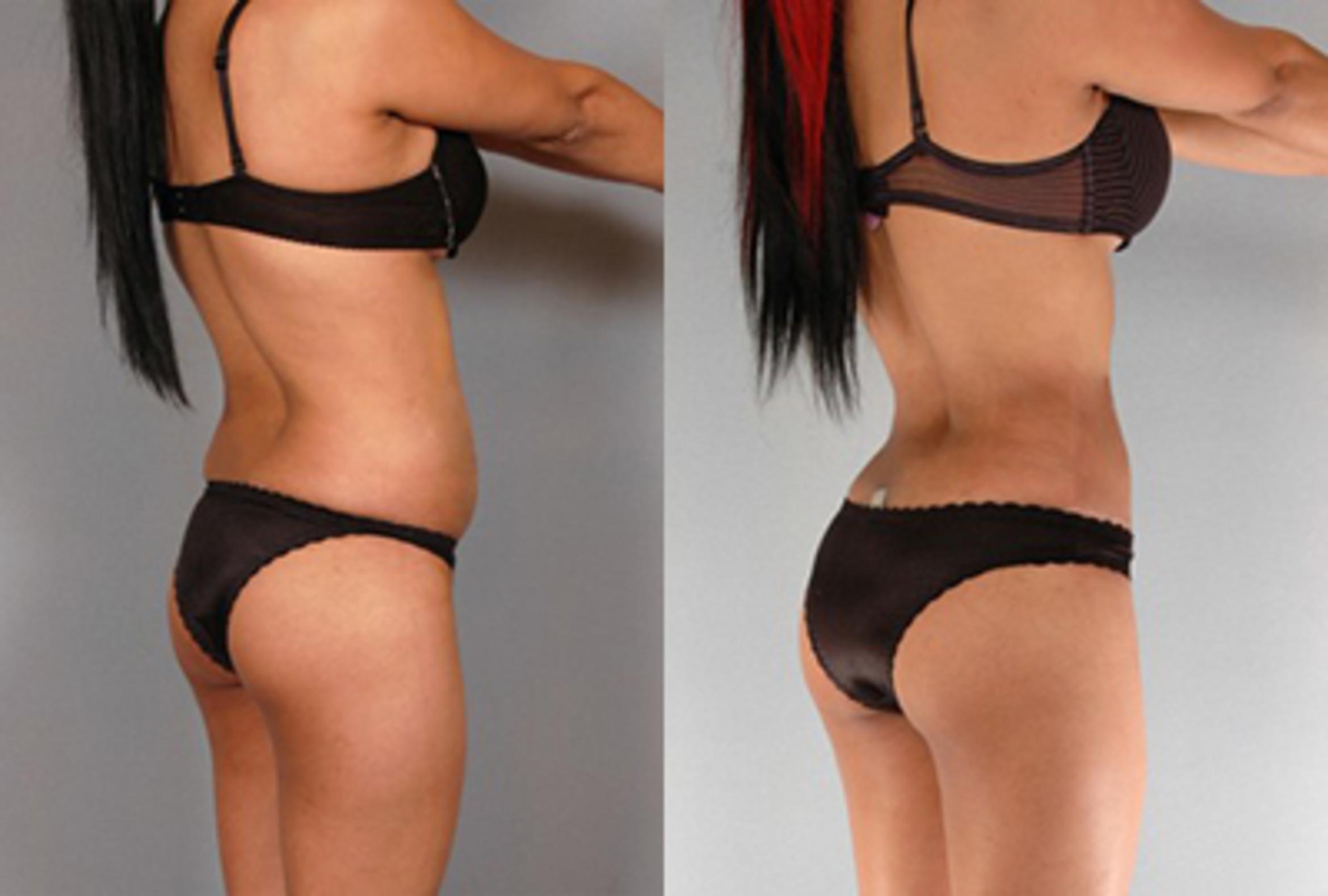 Before & After Brazilian Butt Lift Case 7906 View 1 View in Houston, TX