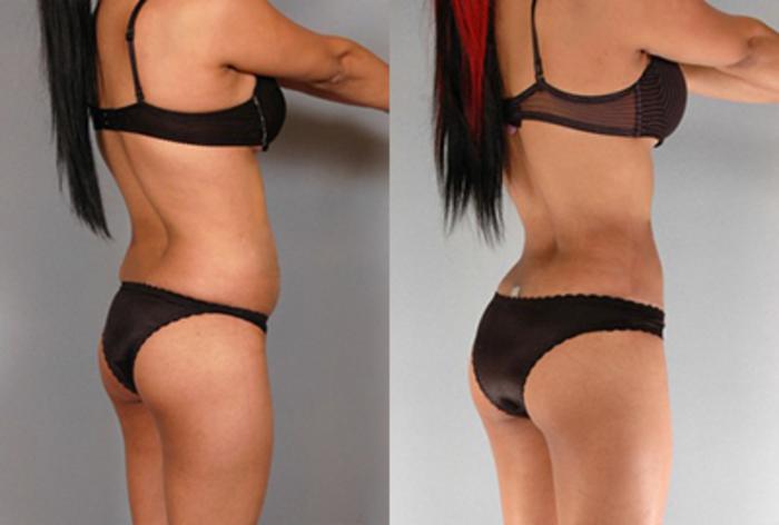 Before & After Brazilian Butt Lift Case 7906 View 1 View in Houston, TX