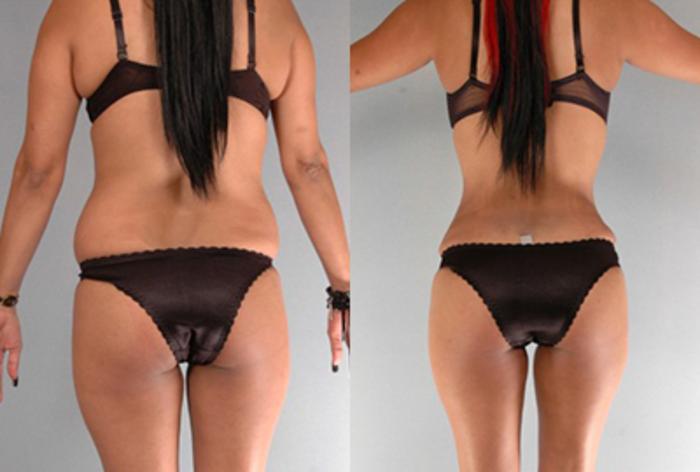 Before & After Brazilian Butt Lift Case 7906 View 2 View in Houston, TX