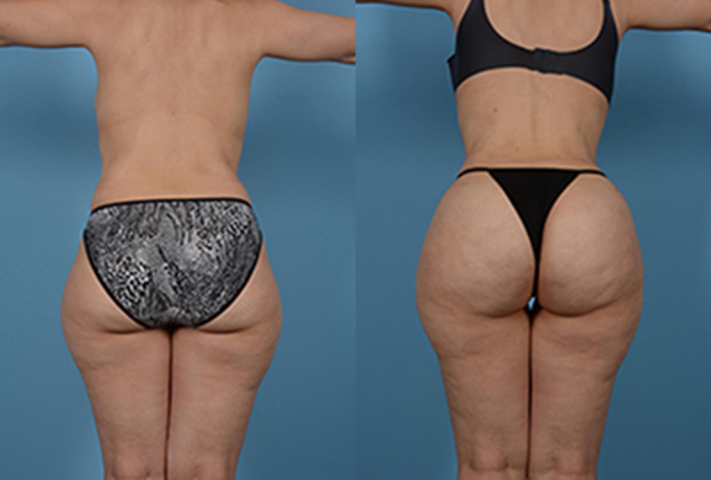 Before & After Brazilian Butt Lift Case 80637 View 1 View in Houston, TX