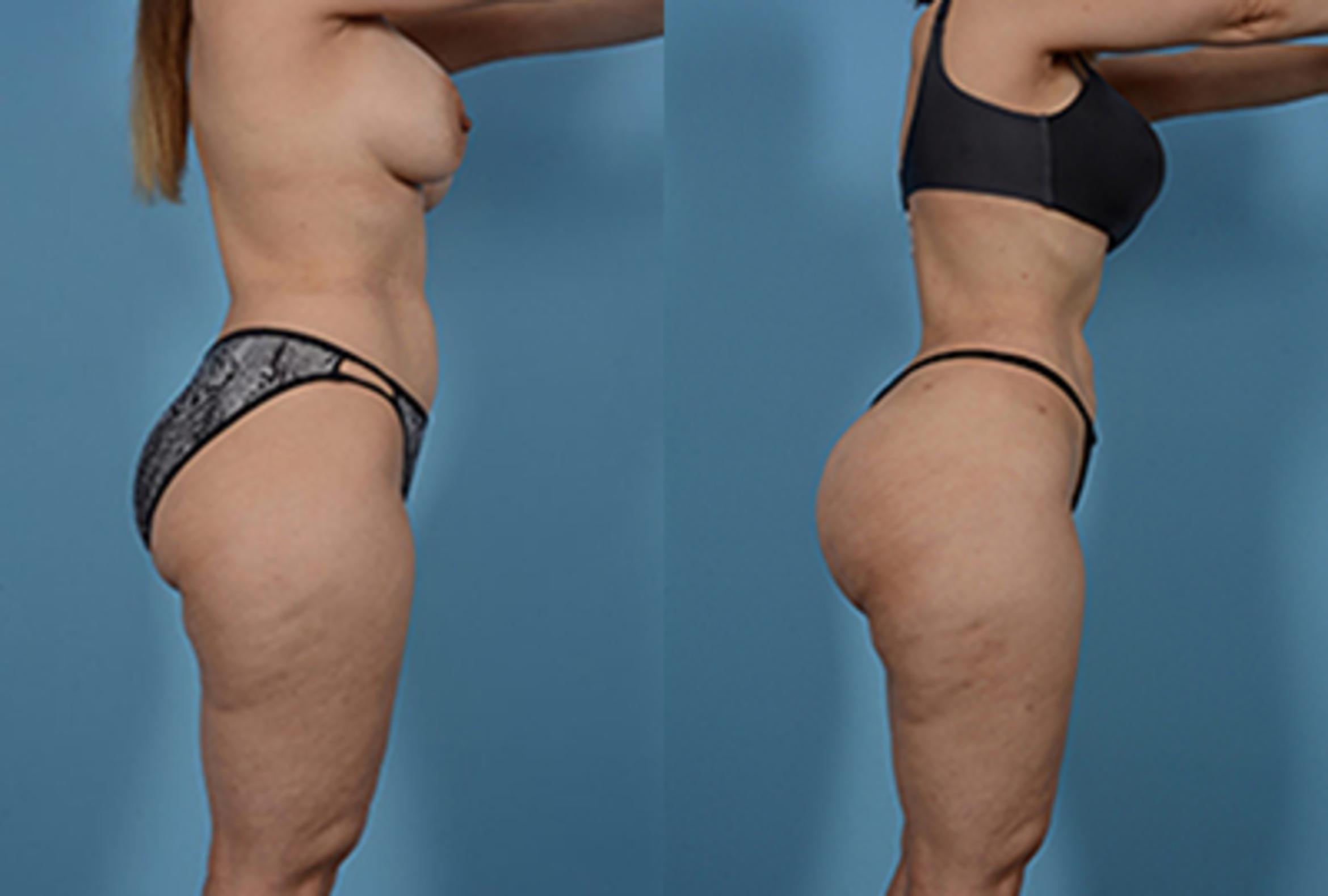 Before & After Brazilian Butt Lift Case 80637 View 2 View in Houston, TX