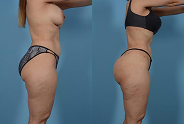 Before & After Brazilian Butt Lift Case 80637 View 2 View in Houston, TX