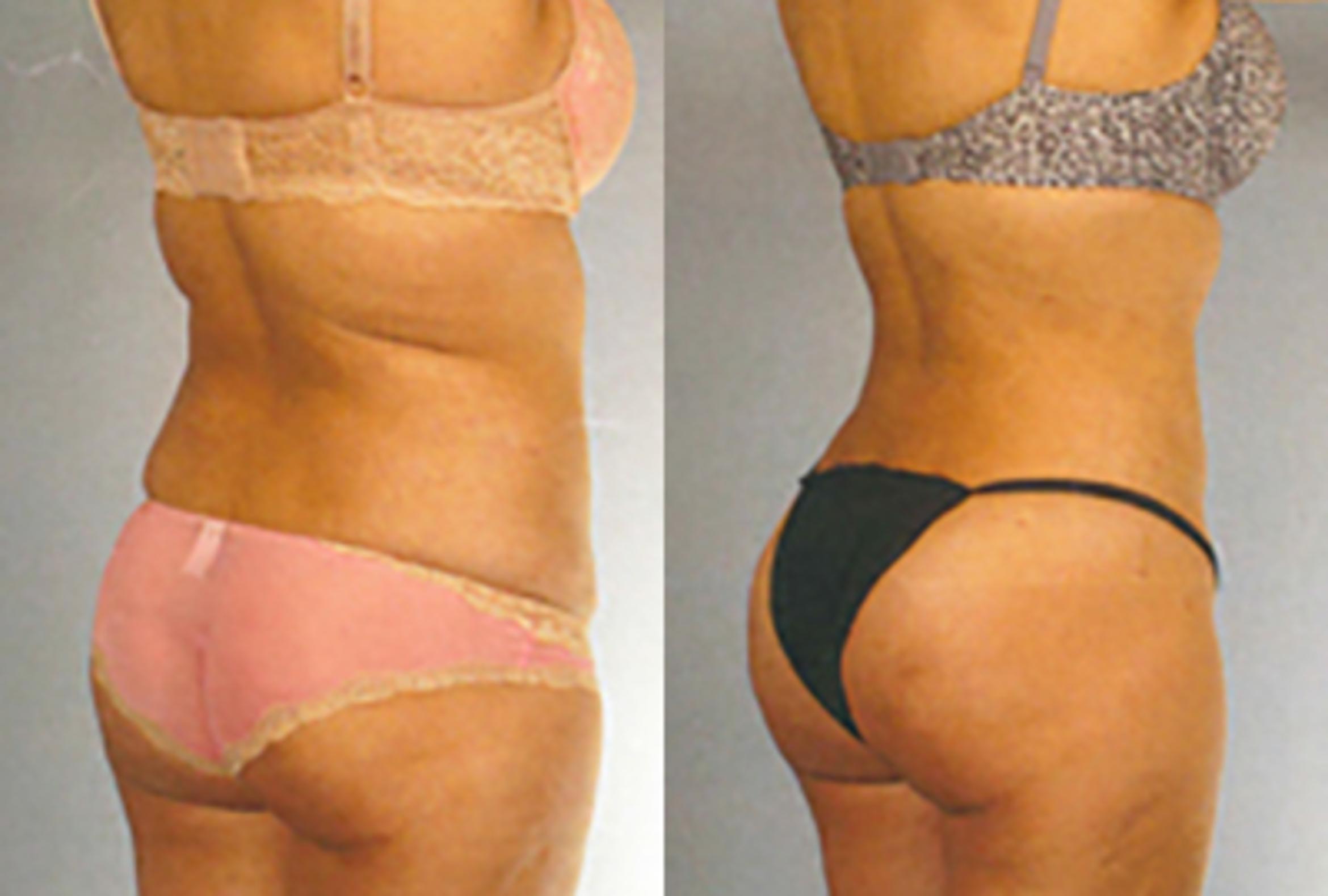 Before & After Brazilian Butt Lift Case 8119 View 1 View in Houston, TX