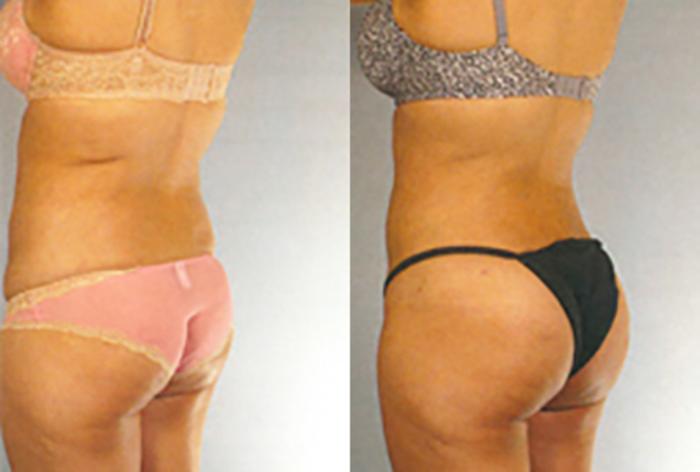 Before & After Brazilian Butt Lift Case 8119 View 2 View in Houston, TX
