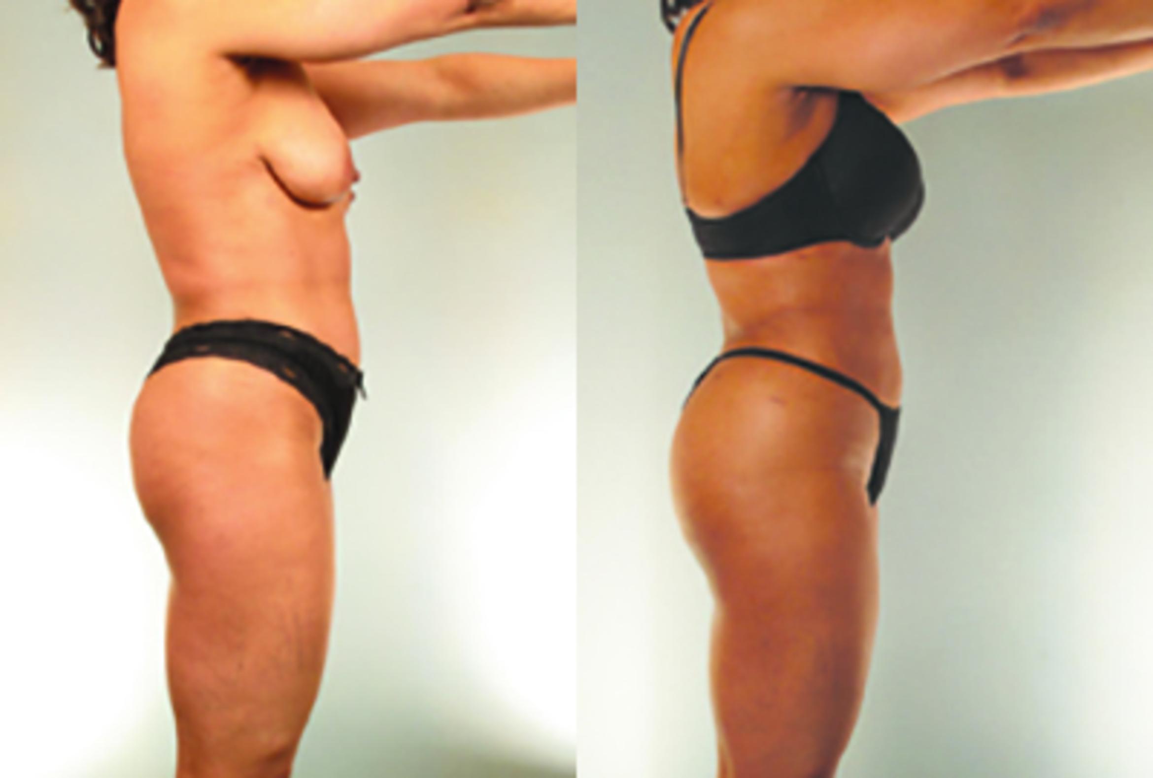 Before & After Brazilian Butt Lift Case 8126 View 1 View in Houston, TX