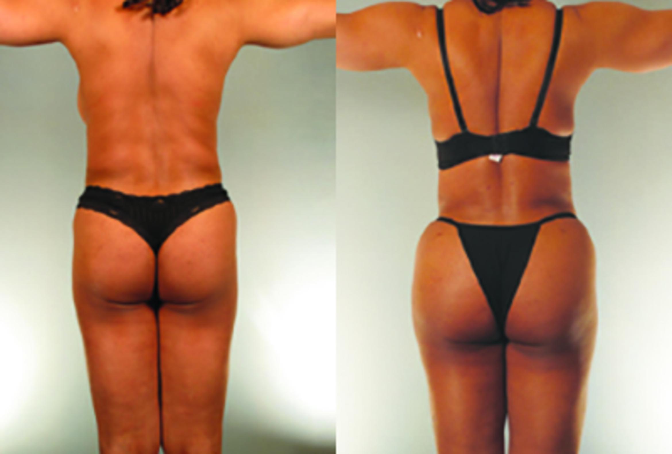 Before & After Brazilian Butt Lift Case 8126 View 2 View in Houston, TX