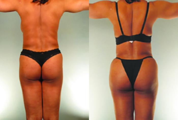 Before & After Brazilian Butt Lift Case 8126 View 2 View in Houston, TX