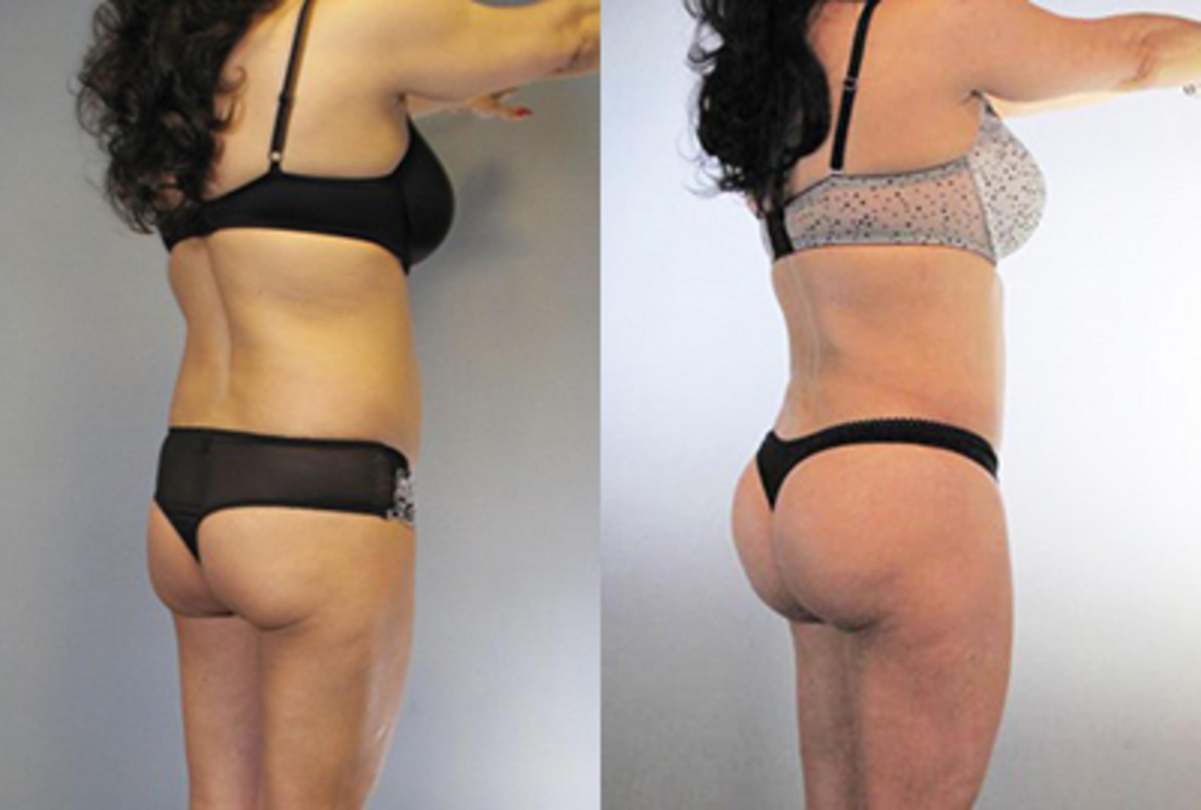 Before & After Brazilian Butt Lift Case 8774 View 1 View in Houston, TX