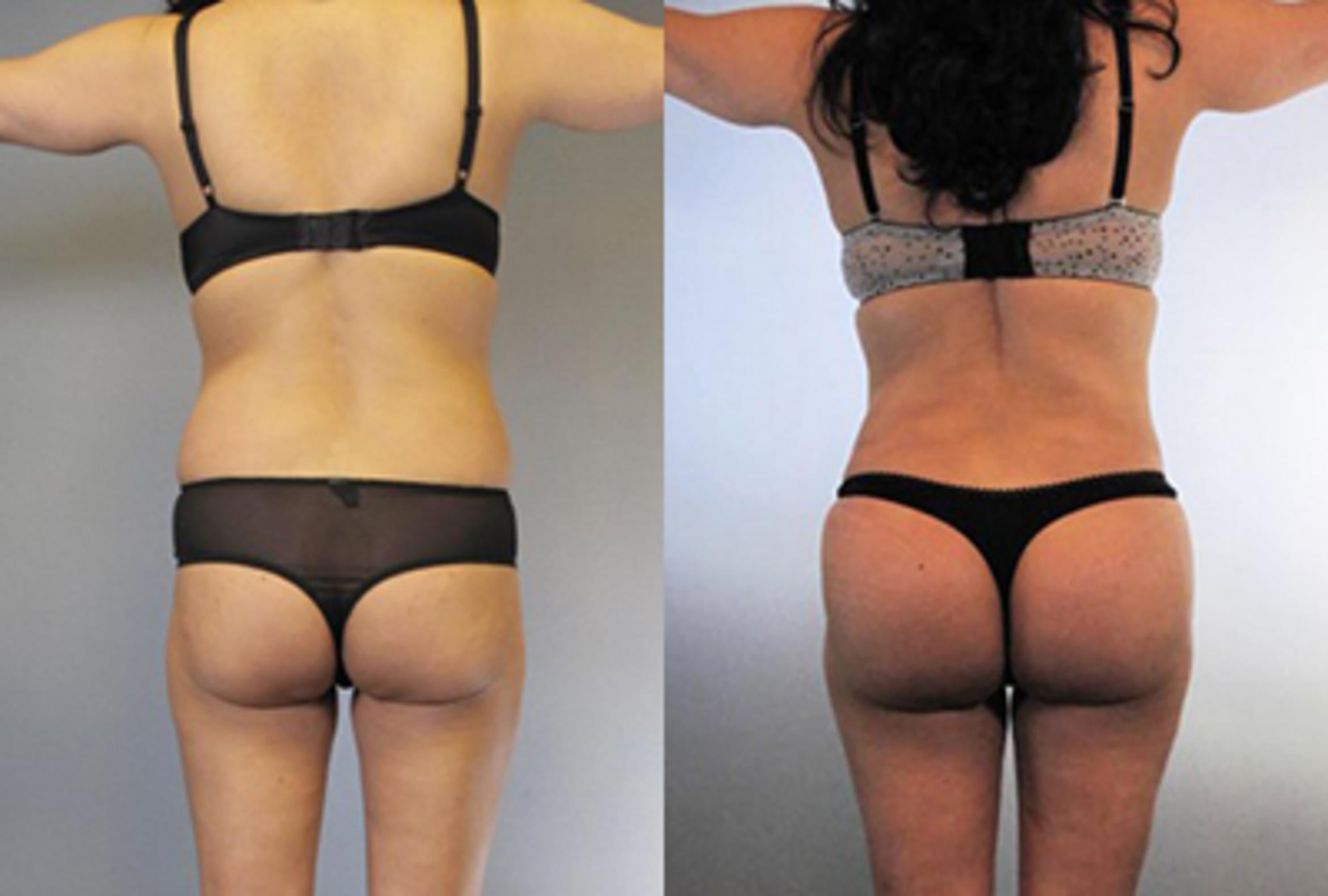 Before & After Brazilian Butt Lift Case 8774 View 2 View in Houston, TX