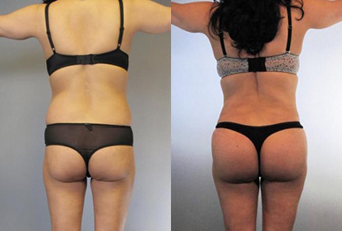 Before & After Brazilian Butt Lift Case 8774 View 2 View in Houston, TX