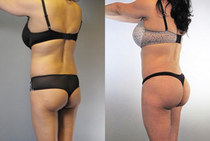 Before & After Brazilian Butt Lift Case 8774 View 3 View in Houston, TX