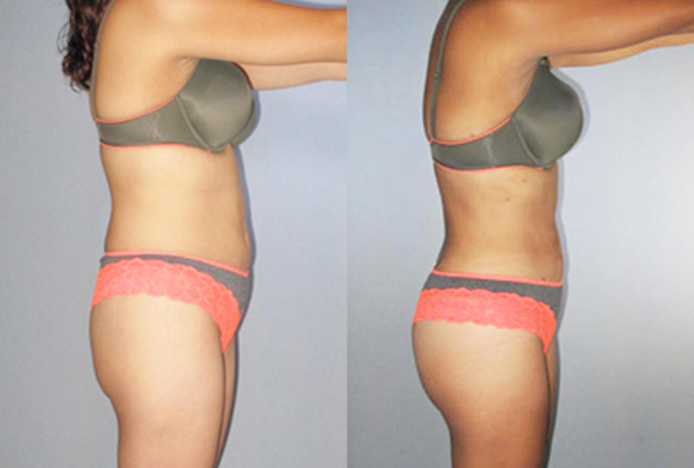 Before & After Brazilian Butt Lift Case 88129999 View 1 View in Houston, TX