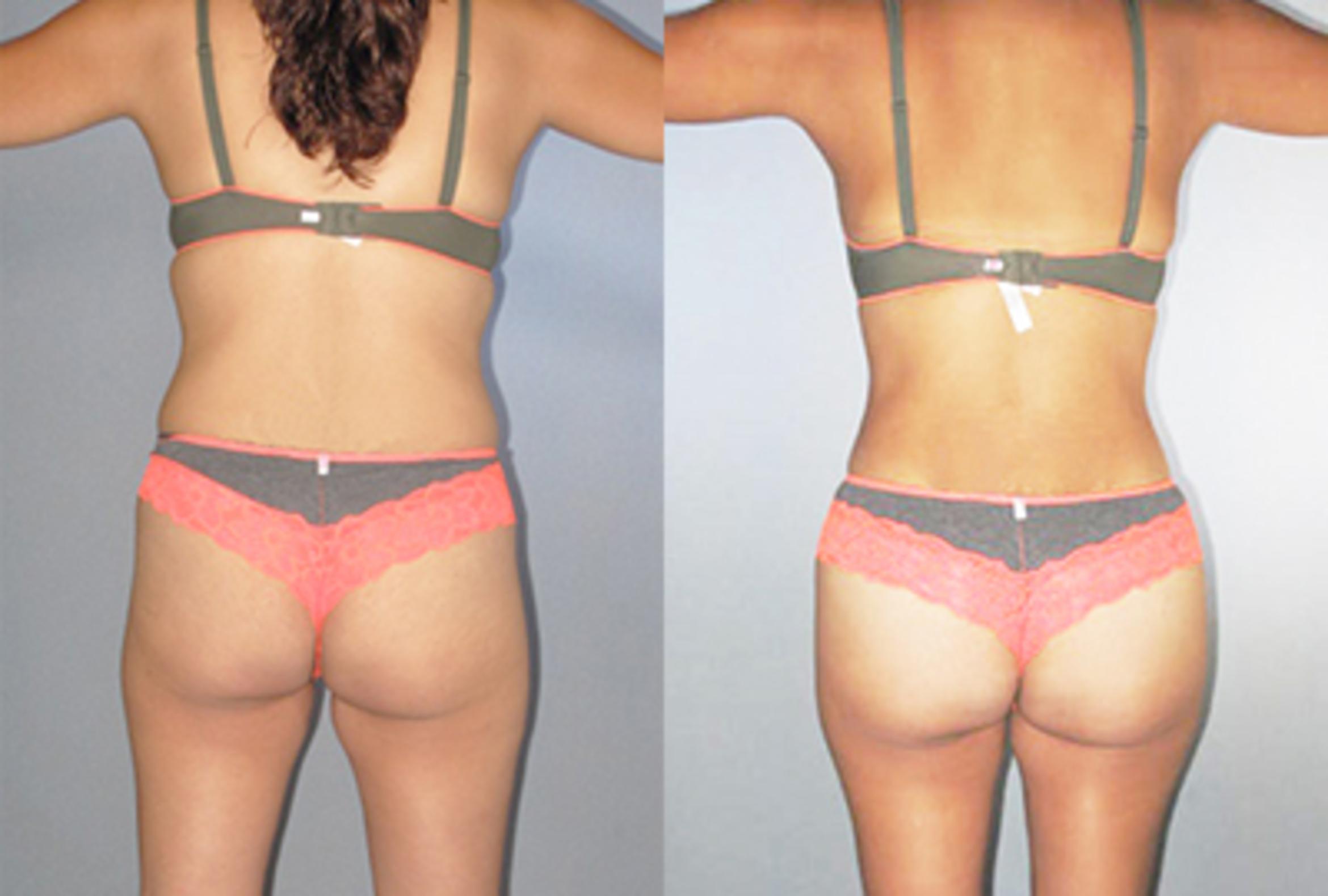 Before & After Brazilian Butt Lift Case 88129999 View 2 View in Houston, TX