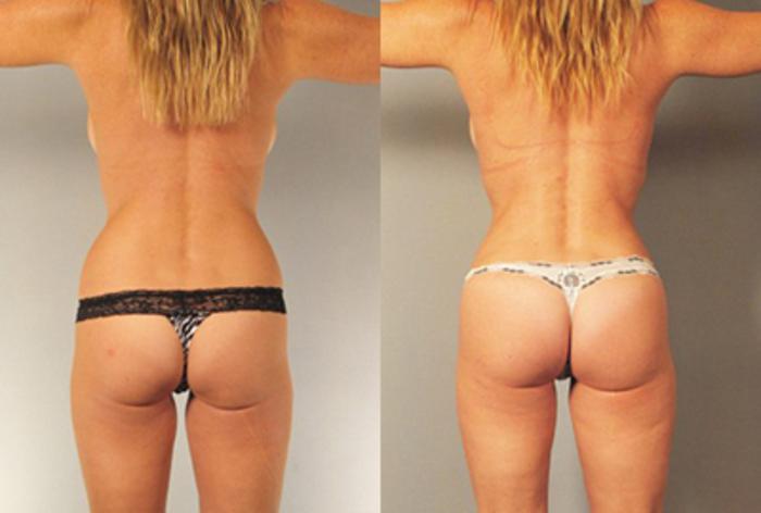 Before & After Brazilian Butt Lift Case 88209999 View 2 View in Houston, TX