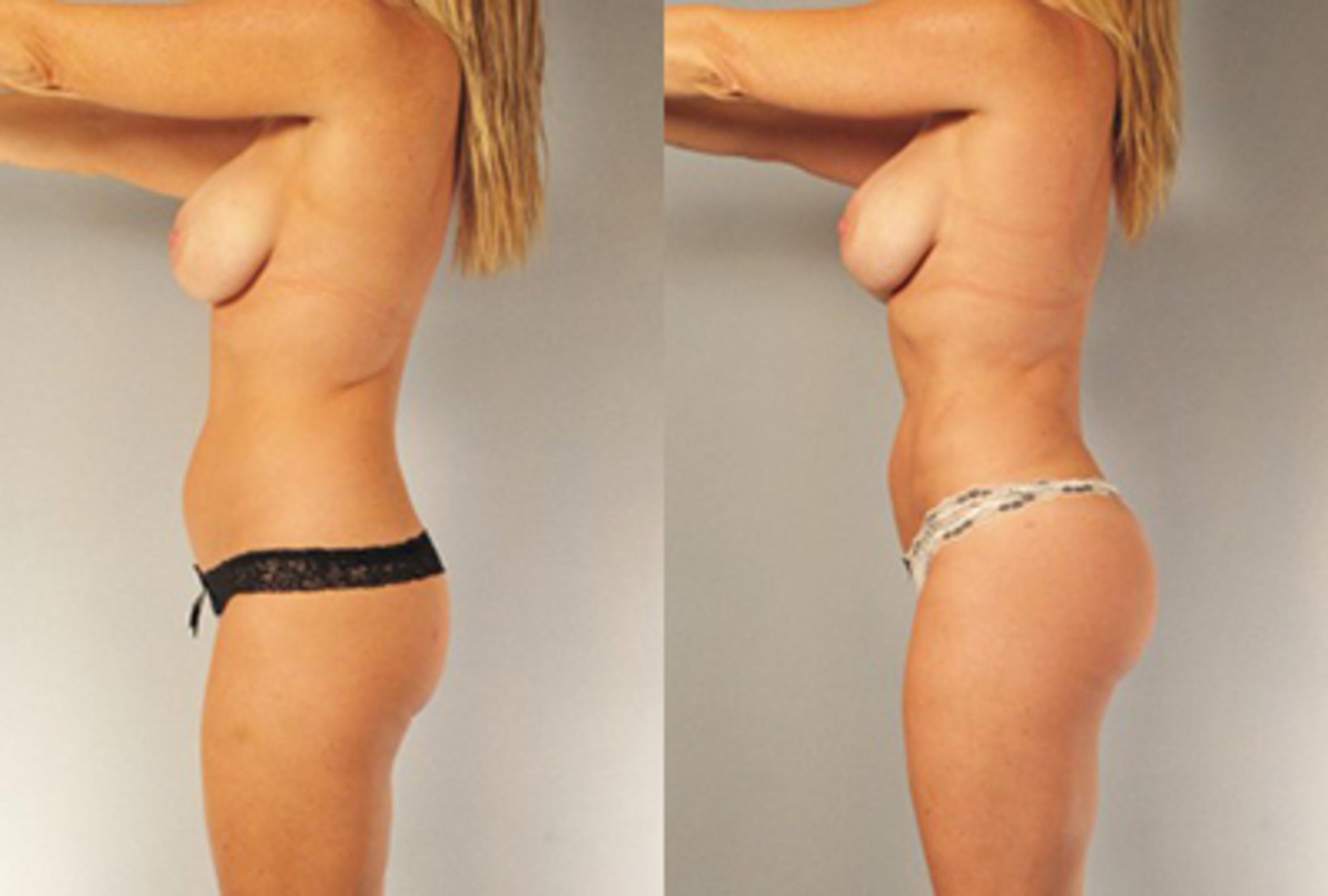 Before & After Brazilian Butt Lift Case 88209999 View 3 View in Houston, TX