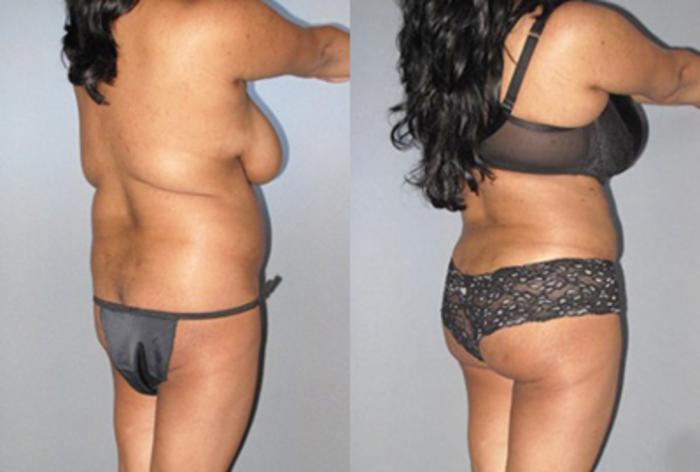 Before & After Brazilian Butt Lift Case 8847 View 1 View in Houston, TX