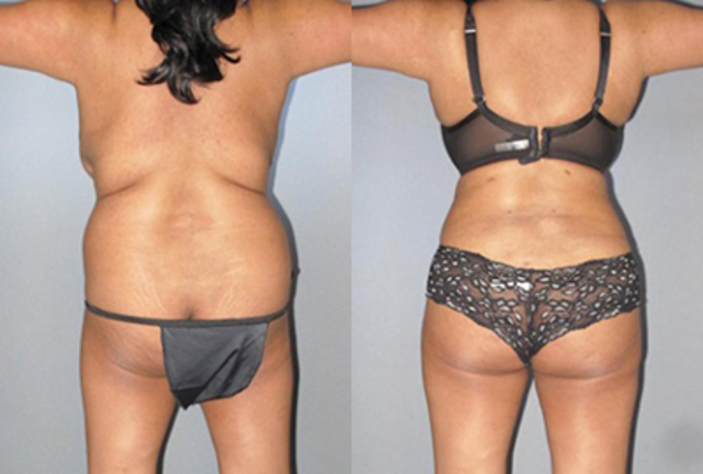 Before & After Brazilian Butt Lift Case 8847 View 2 View in Houston, TX