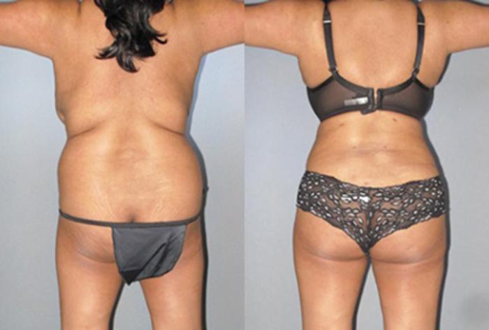 Before & After Brazilian Butt Lift Case 8847 View 2 View in Houston, TX