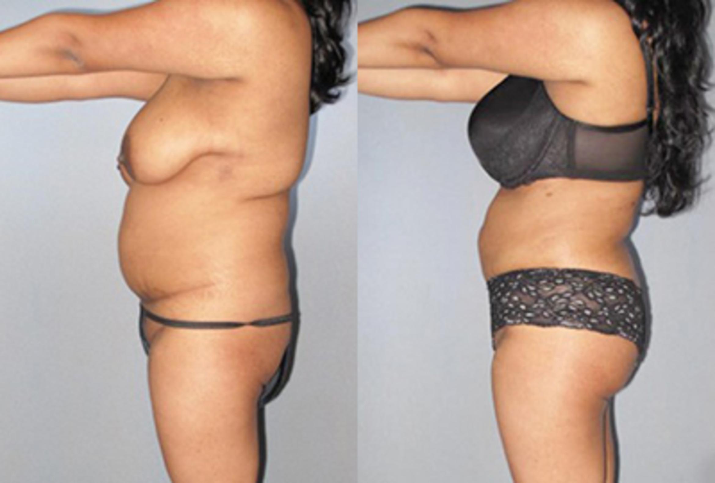 Before & After Brazilian Butt Lift Case 8847 View 3 View in Houston, TX