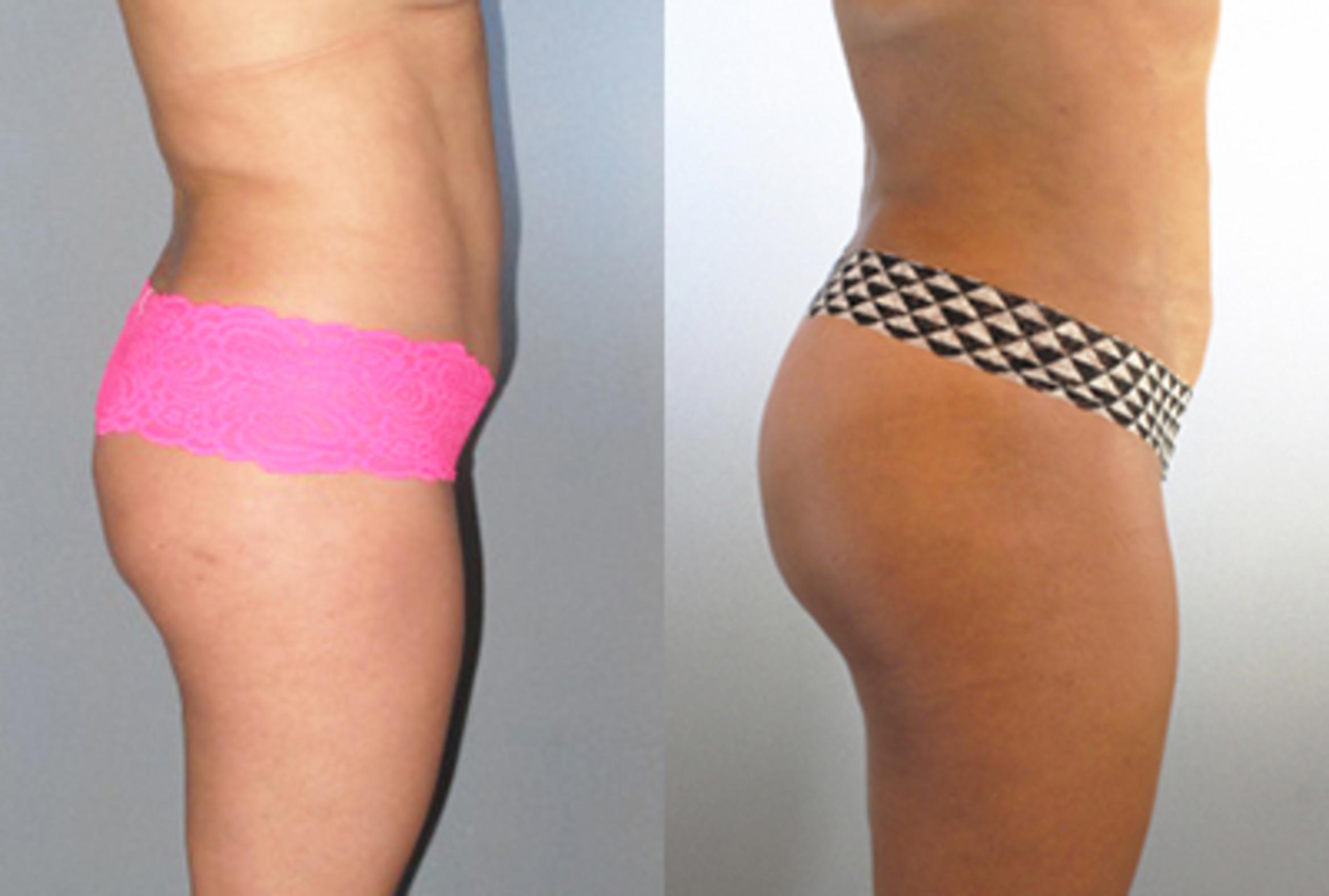 Before & After Brazilian Butt Lift Case 88589999 View 1 View in Houston, TX