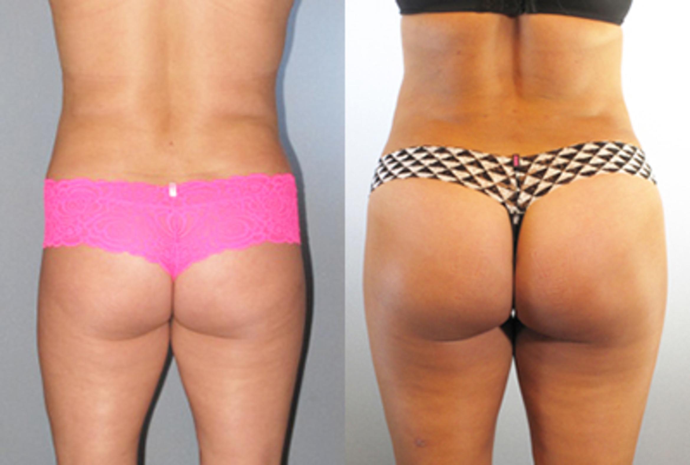 Before & After Brazilian Butt Lift Case 88589999 View 2 View in Houston, TX