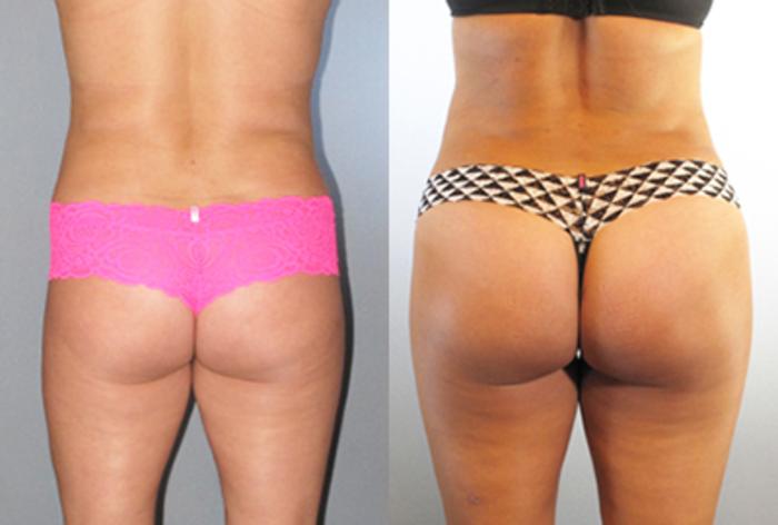 Before & After Brazilian Butt Lift Case 88589999 View 2 View in Houston, TX