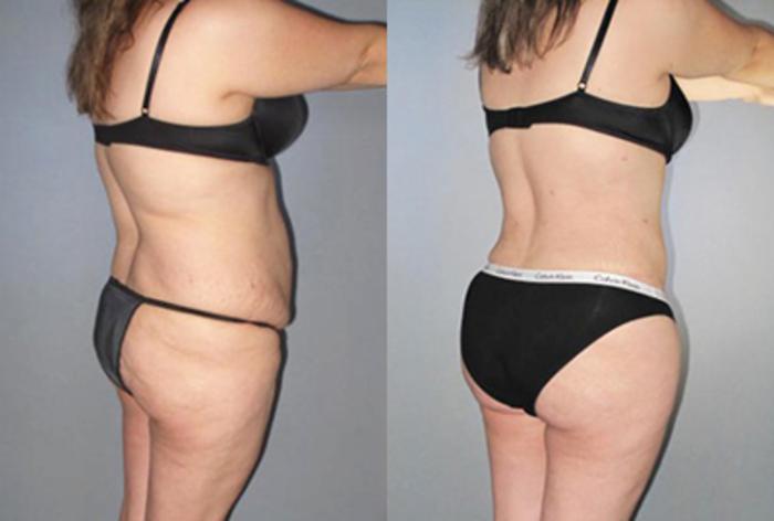 Before & After Brazilian Butt Lift Case 88659999 View 1 View in Houston, TX