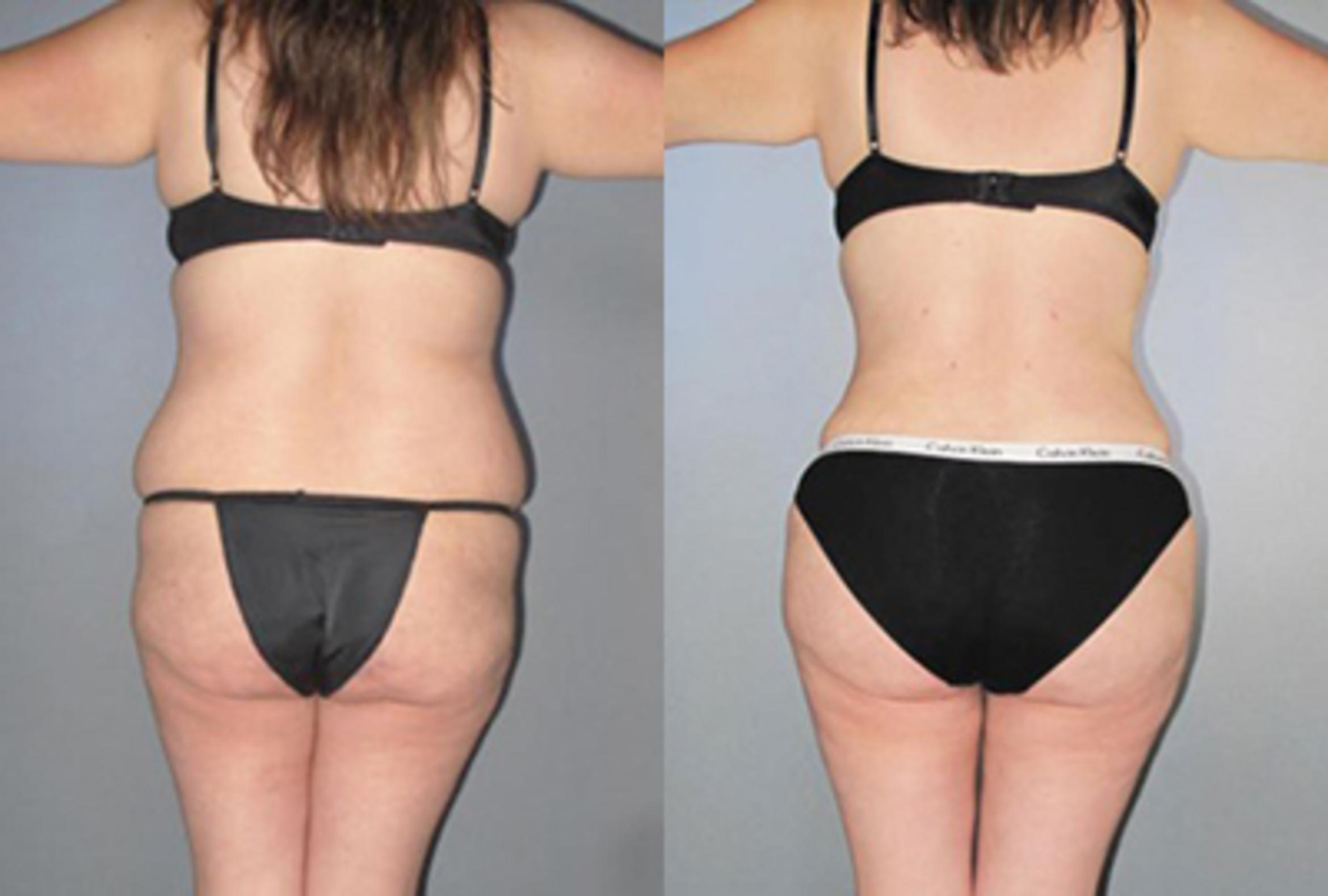 Before & After Brazilian Butt Lift Case 88659999 View 2 View in Houston, TX