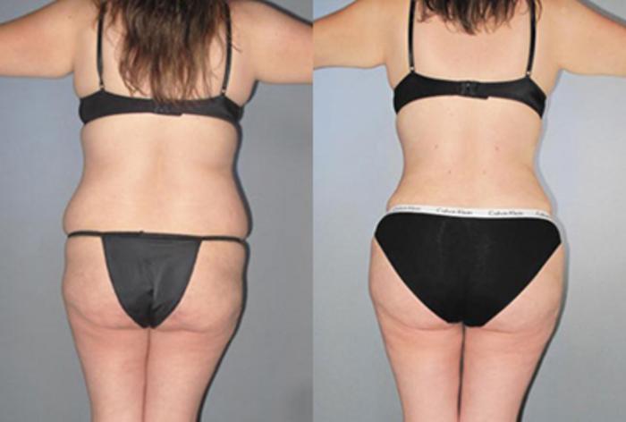 Before & After Brazilian Butt Lift Case 88659999 View 2 View in Houston, TX