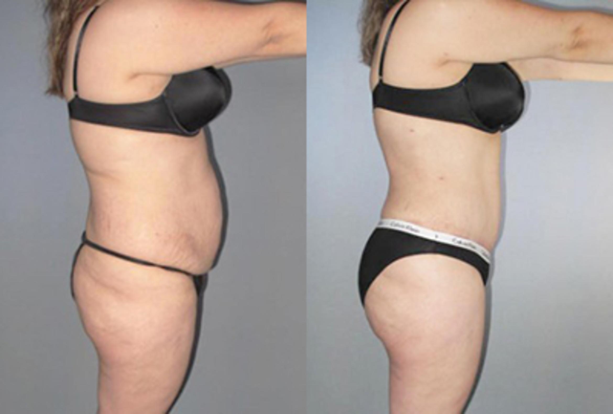 Before & After Brazilian Butt Lift Case 88659999 View 3 View in Houston, TX