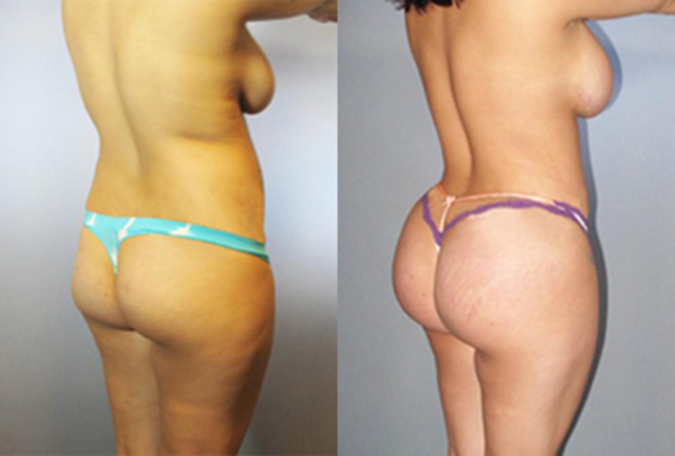Before & After Brazilian Butt Lift Case 88749999 View 1 View in Houston, TX
