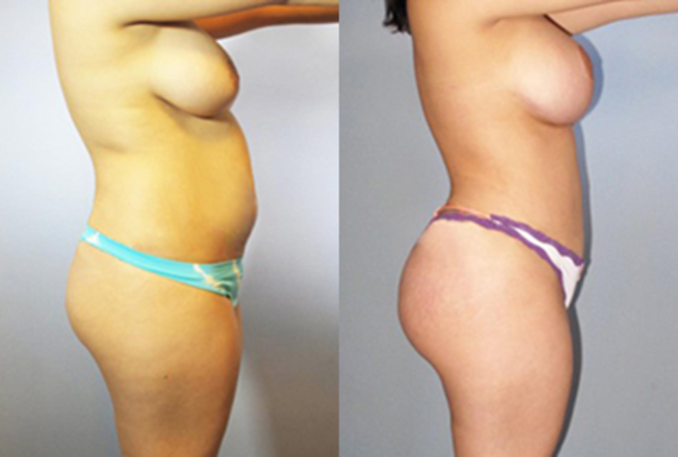 Before & After Brazilian Butt Lift Case 88749999 View 2 View in Houston, TX