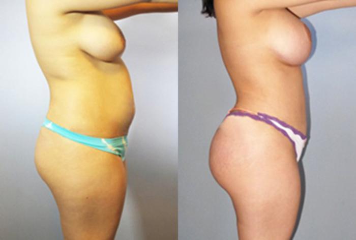 Before & After Brazilian Butt Lift Case 88749999 View 2 View in Houston, TX