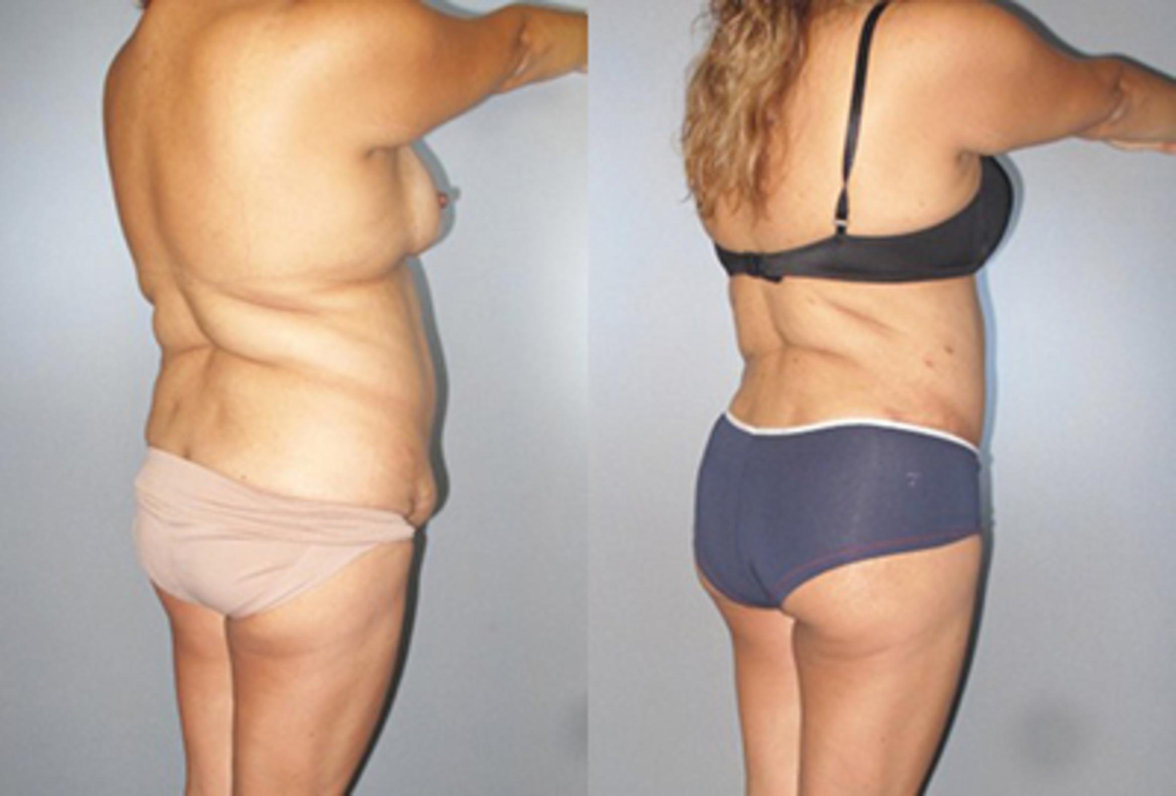 Before & After Brazilian Butt Lift Case 8884 View 1 View in Houston, TX