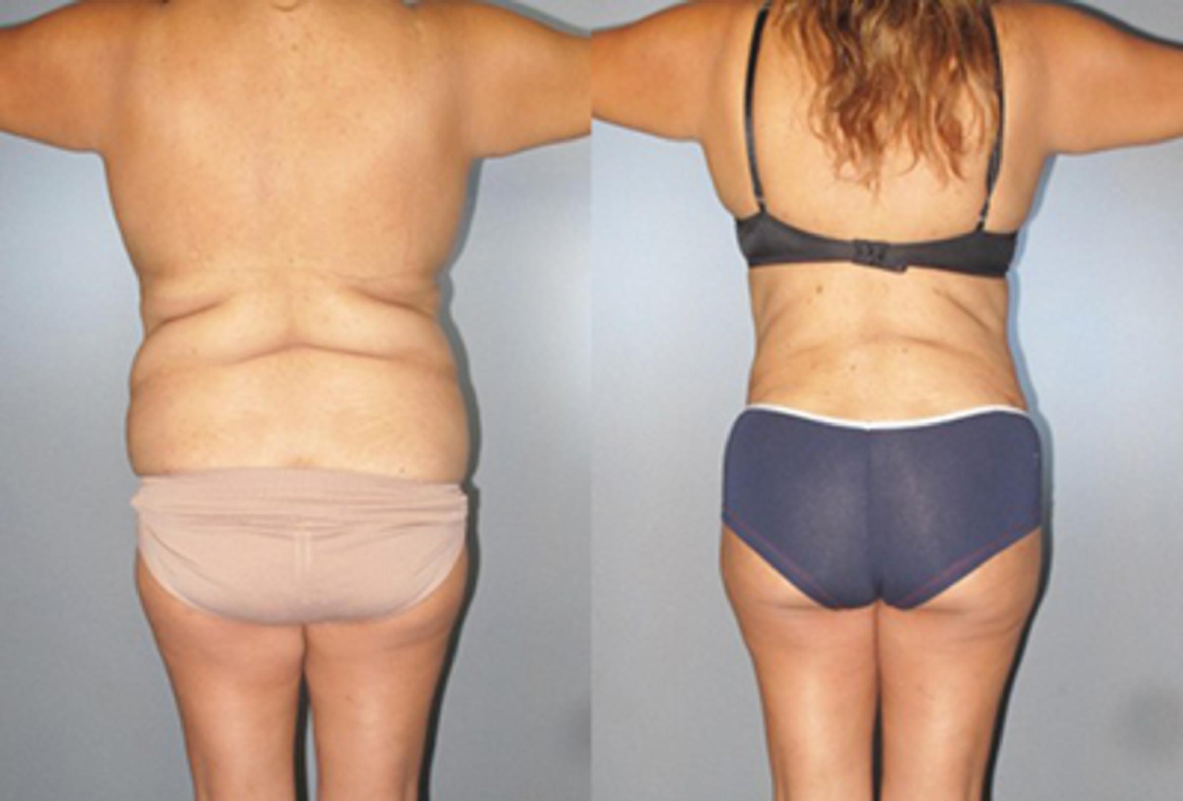 Before & After Brazilian Butt Lift Case 8884 View 2 View in Houston, TX