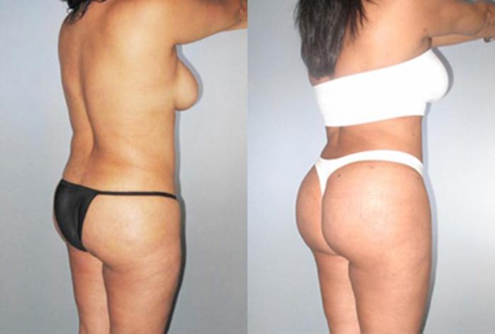 Before & After Brazilian Butt Lift Case 89449999 View 1 View in Houston, TX