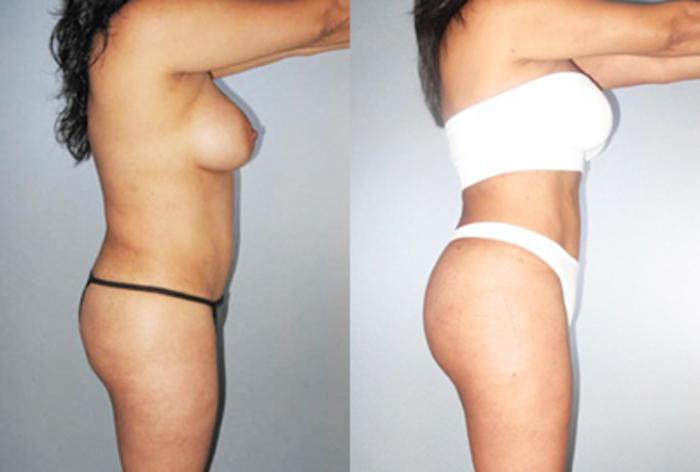 Before & After Brazilian Butt Lift Case 89449999 View 3 View in Houston, TX