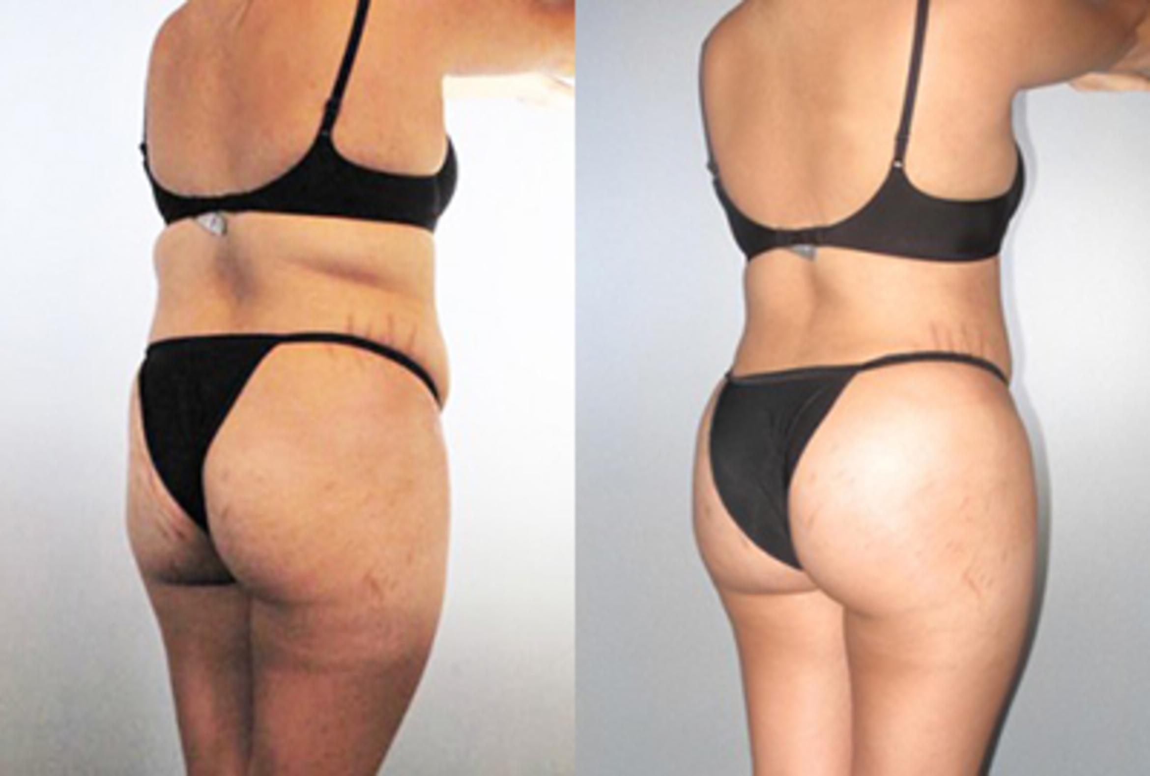 Before & After Brazilian Butt Lift Case 89709999 View 1 View in Houston, TX