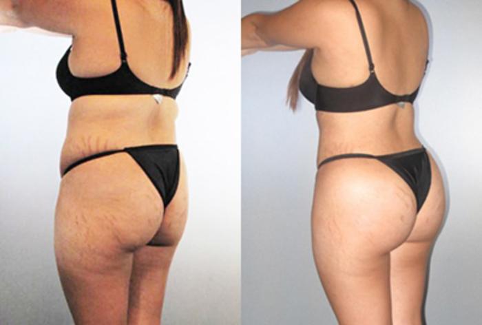 Before & After Brazilian Butt Lift Case 89709999 View 2 View in Houston, TX