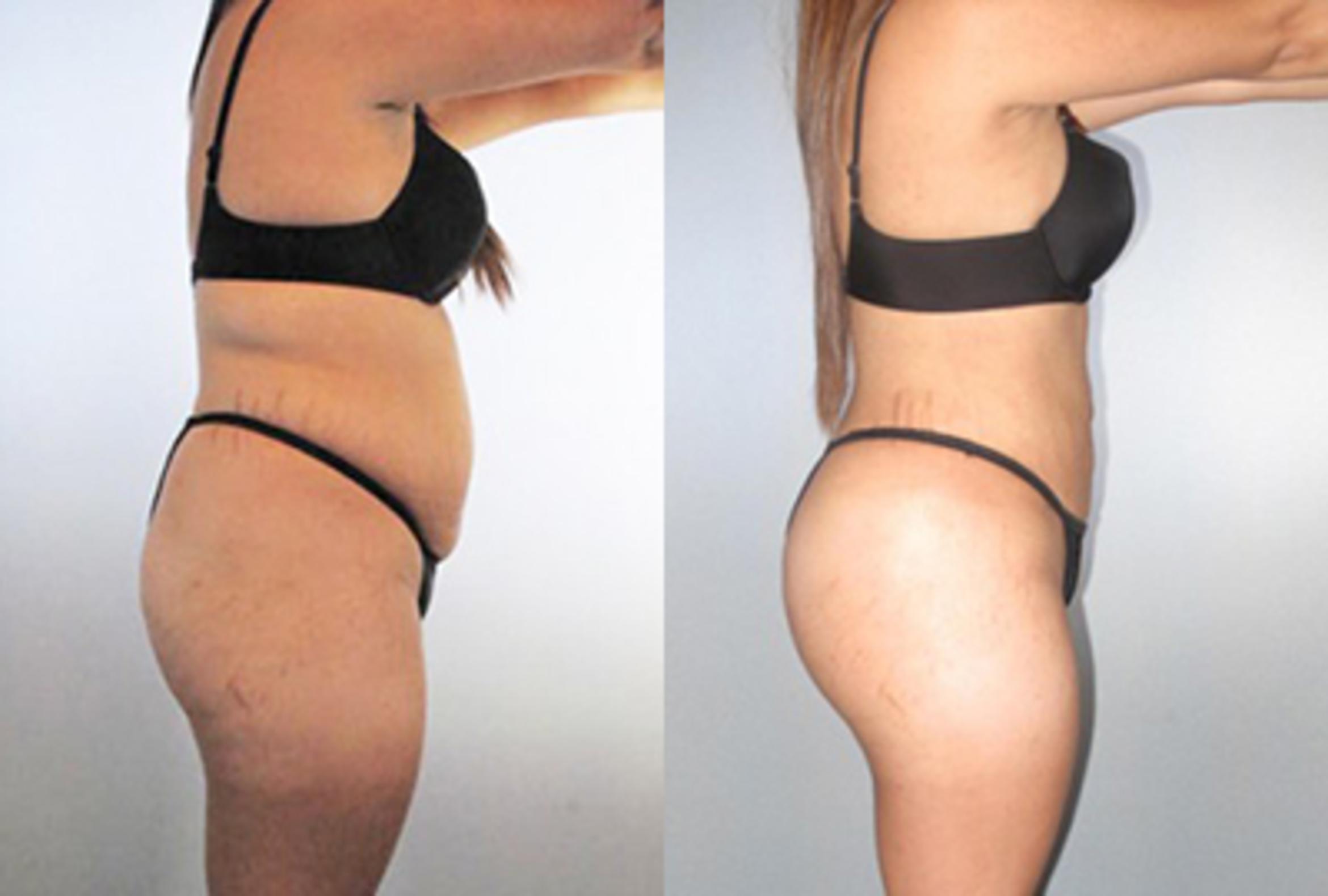 Before & After Brazilian Butt Lift Case 89709999 View 3 View in Houston, TX