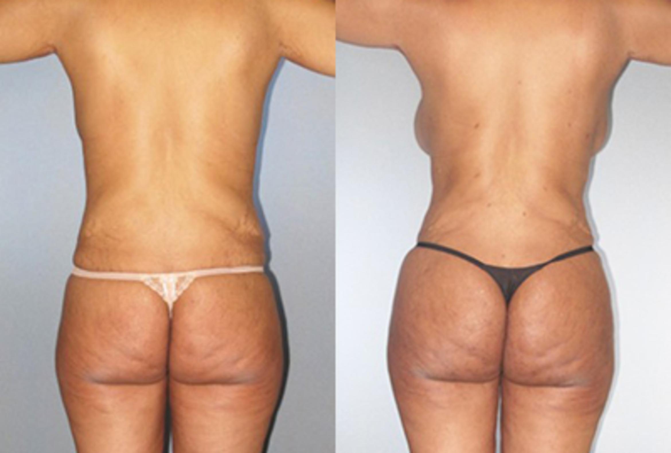 Before & After Brazilian Butt Lift Case 9072 View 1 View in Houston, TX