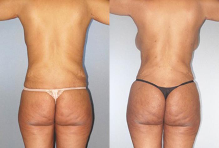 Before & After Brazilian Butt Lift Case 9072 View 1 View in Houston, TX