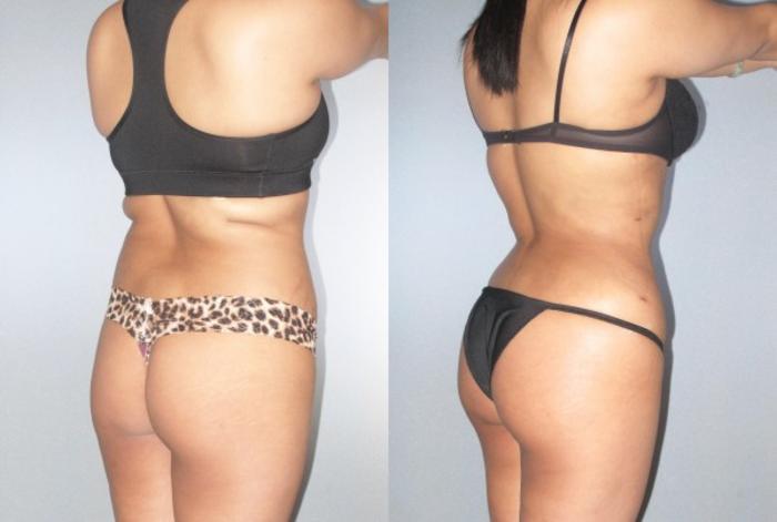 Before & After Brazilian Butt Lift Case 9081 View 1 View in Houston, TX