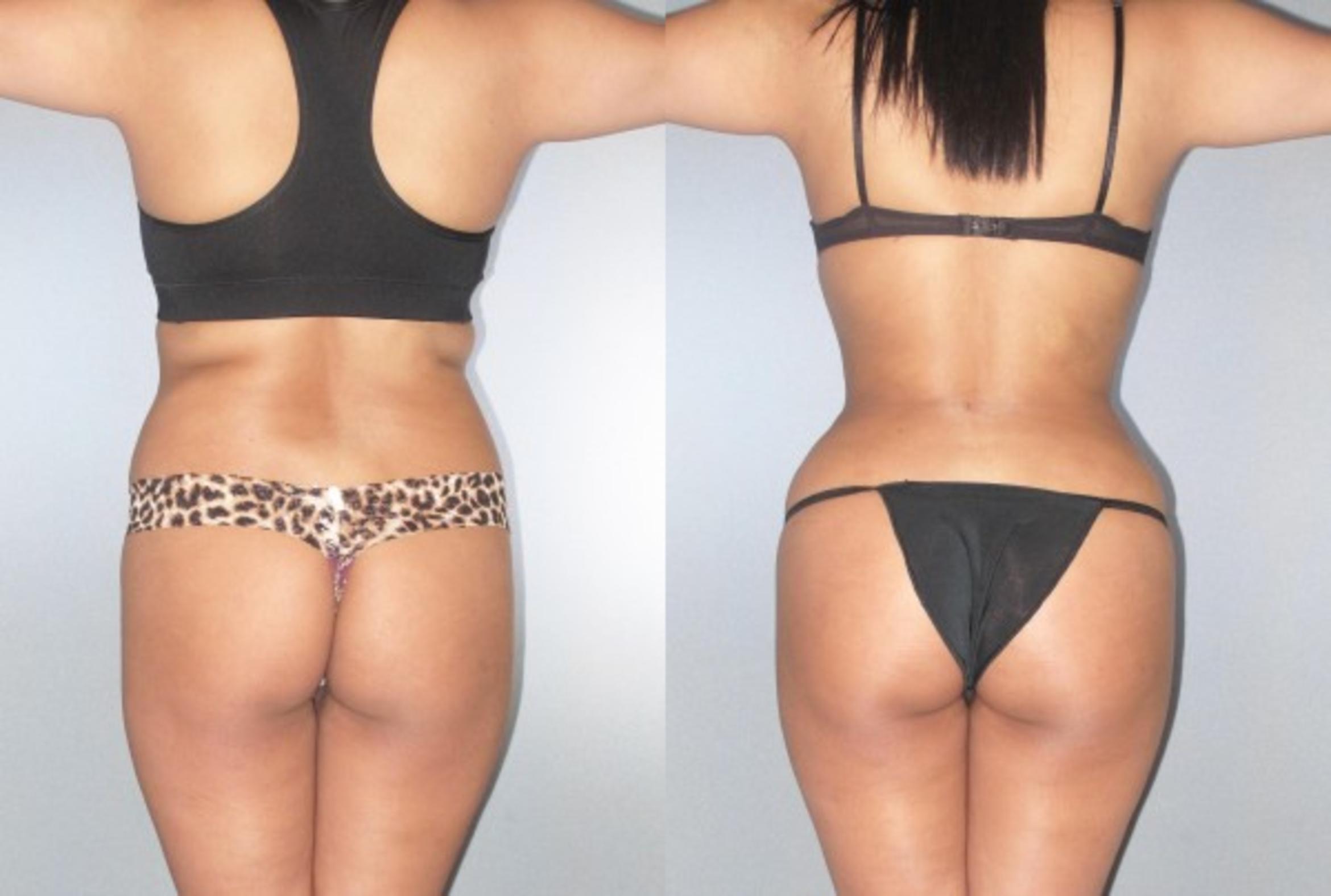 Before & After Brazilian Butt Lift Case 9081 View 2 View in Houston, TX