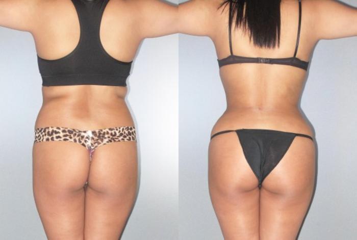 Before & After Brazilian Butt Lift Case 9081 View 2 View in Houston, TX